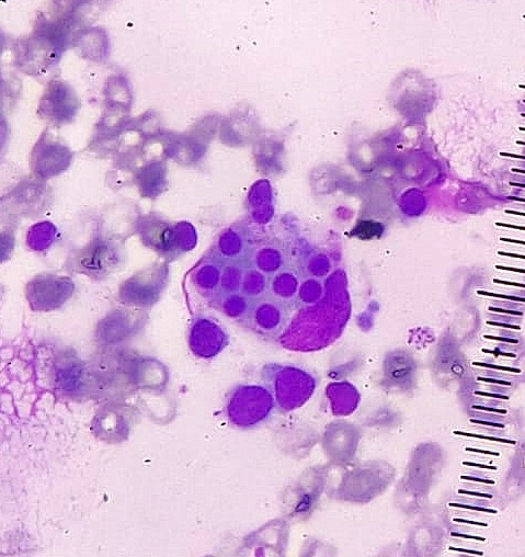 Bone marrow imprint smear show ahistiocyte engulfing many lymphocytes(Giemsa stain, oil immersion).