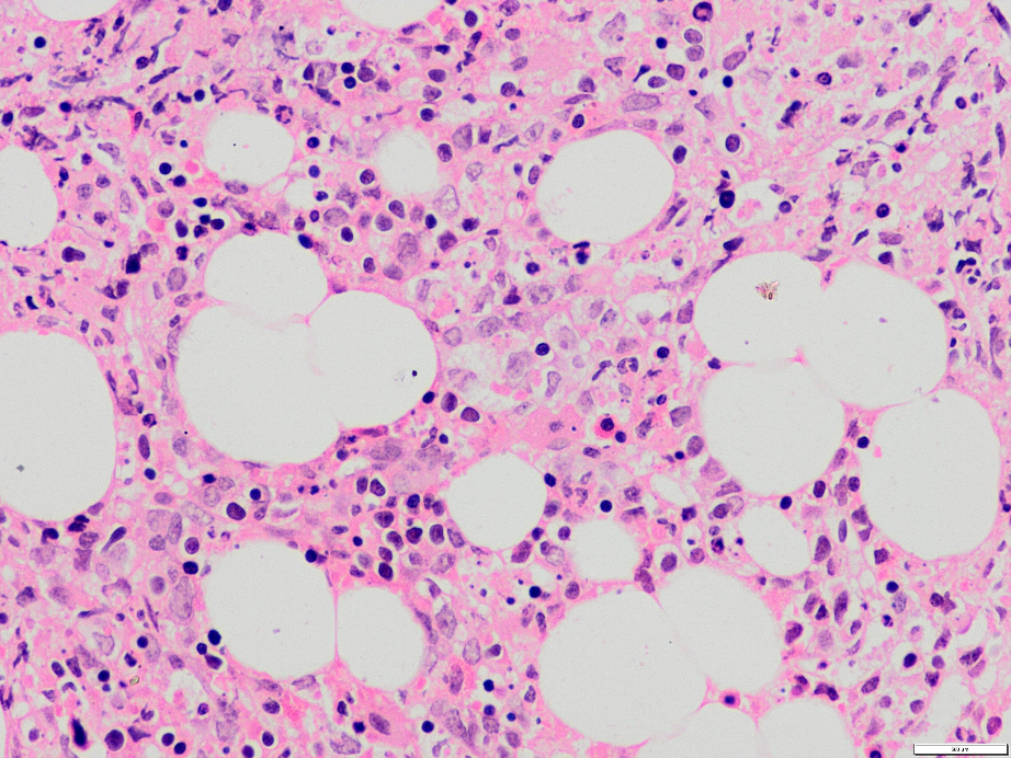 Bone marrow biopsy showed increased histiocytes and these histiocytes show hemophagocytosis, engulfing erythroblasts, platelets as well as lymphocytes (H&E stain, 4000X).
