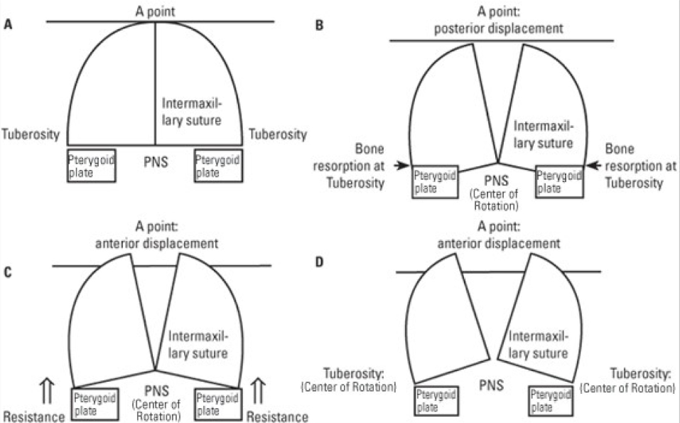 Alt-Ramec. A) Maxilla before expansion.; B): Posterior displacement of maxilla after RME.; C): Anterior displacement of maxilla by hyrax expander using Alt-Ramec protocol.; D): Anterior displacement of maxilla by double hinged expander using Alt-Ramec protocol.