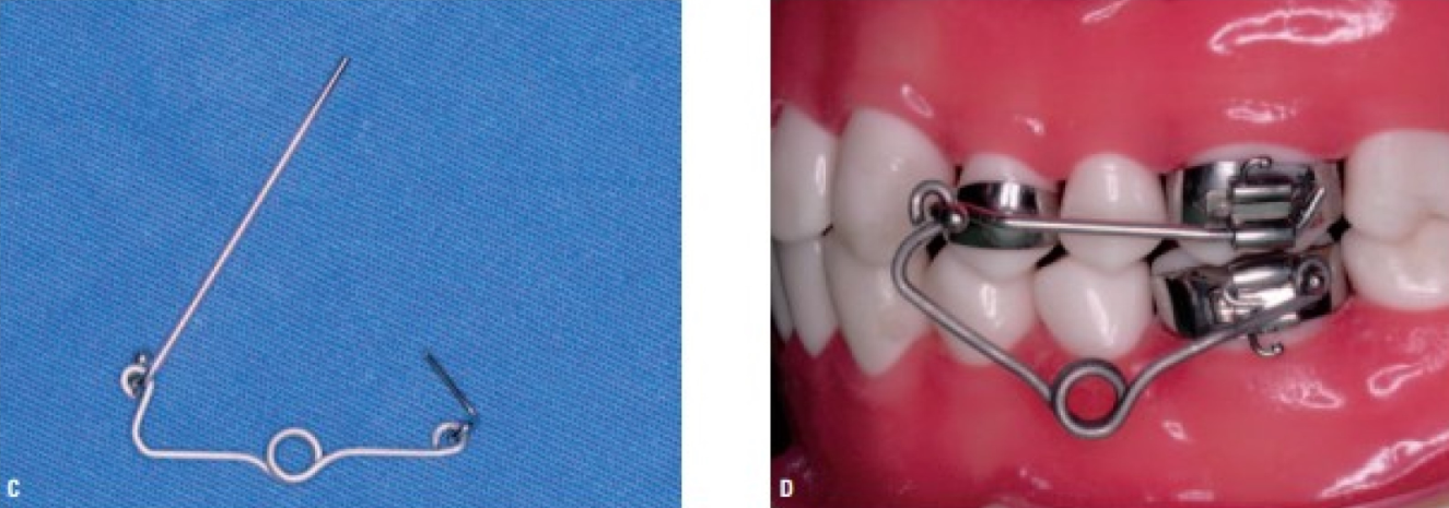 Intra-oral maxillary protraction spring.