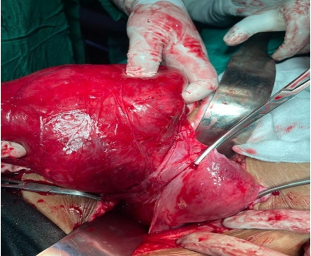Intra operative findings of large broad ligament fibroid