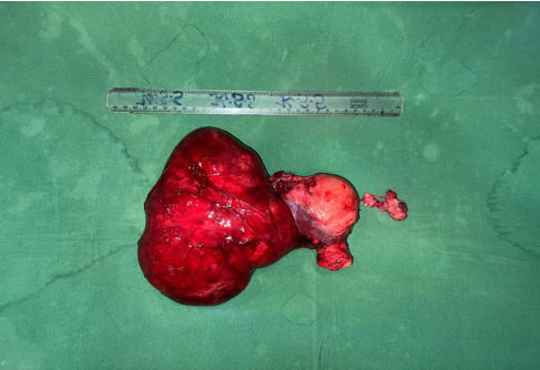 Gross picture showing broad ligament fibroid with uterus