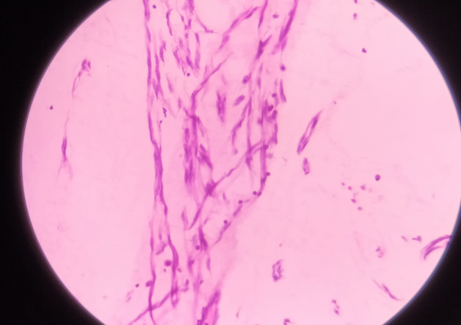 Histopathology image showing hyaline degeneration