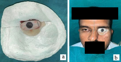 a: Luting of ocular button to flat shell; b: Orientation of eye shell.