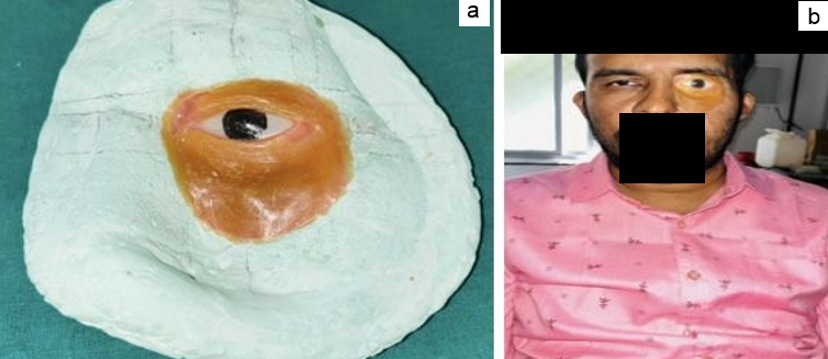 0:a: Final wax trail of prosthesis on cast; b: Final wax trail of prosthesis on patient.