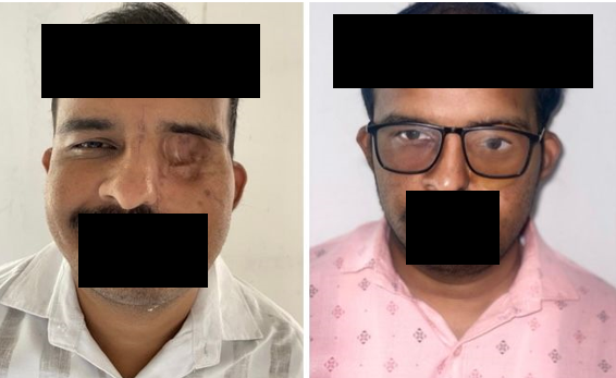 a: Pre-prosthetic photograph; b: Final prosthesis photograph