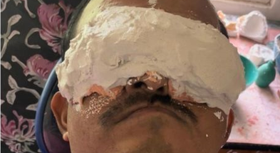 Impression of the defect region using alginate along with reinforcement by plaster.