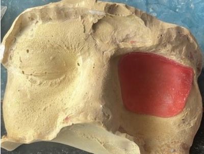 Fabrication of wax pattern.