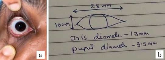 a: Intact eye; b: Dimensions measured from intact eye