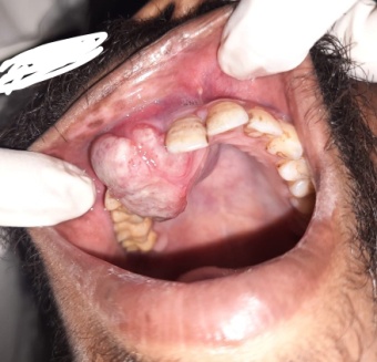 Intra oral appearance
