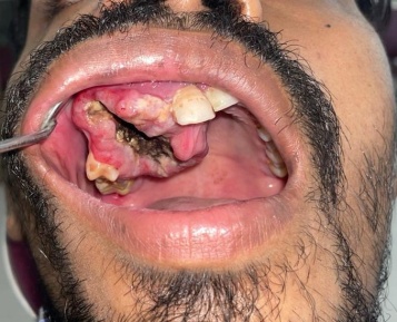 No healing of the biopsy wound