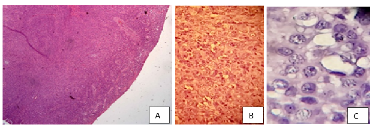 A diagnosis of poorly differentiated malignant neoplasm. A) 4X, B) 10X, C) 40X