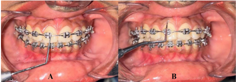 Interpretation of bleeding on probing, white spot lesion, orthodontic plaque index, and gingival index using A. Williams periodontal probe B. CPITN probe (community and periodontal treatment need index probe)