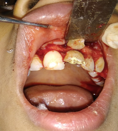 PRF placement into surgical cavity