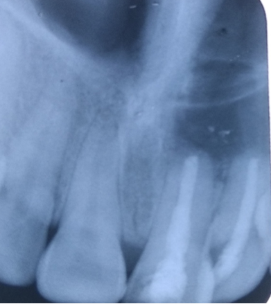 Post op radiograph at 3 month