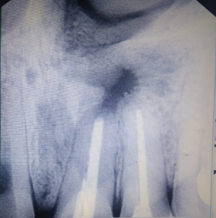 Post Op radiograph T 6 month