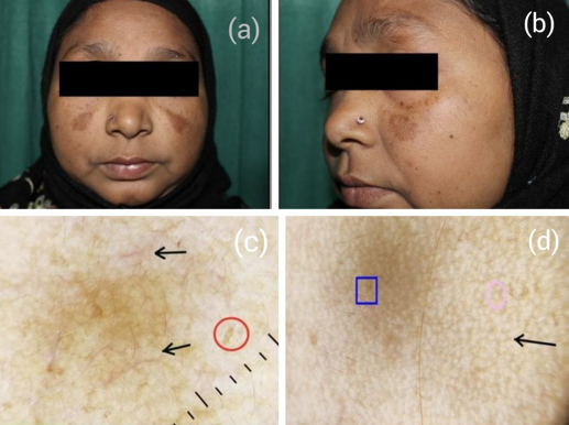 Epidermalmelasma; a & b: Shows clinical image of epidermal melisma; c: Dermatoscopy shows black arrow: Telangiectasia, Red circle: Dots and globules; d: Black arrow: Reticuloglobular pigment pattern, Blue box: Regular accentuation of normal pigment pattern,pink circle: annular pattern