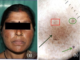 Mixed melisma; a: Clinical image; b: Dermatoscopy shows Black arrow: Irregular accentuation of pseudo network.