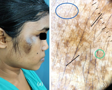 Post inflammatory hyperpigmentation; a: Clinical image; b: Dermatoscopy shows black arrow: brown dots and granules, green circle: Brown black structureless areas, Blue circle: pseudoreticular honeycomb pattern (PRHP)