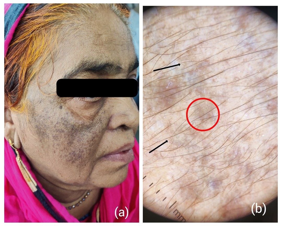 Nevus of Ota; a: Clinical image; b: Dermatoscopy shows red circle: Bluish black blotches and structureless areas; black arrow: Reticuloglobular pattern