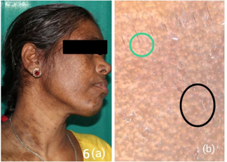 Pigmentedcontact dermatitis; a: Clinical image; dermatosocopy shows; b: Black circle: pseudo network with non-pigmented follicular openings; Green circle: Fine pigment granules with perifollicular whitish halo.