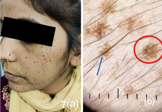 Freckles; a: Clinical Image; b: Dermatoscopy shows blue arrow: Uniform brown pigmentation, red circle: Uniform pigmentation with Moth Eaten Edges.