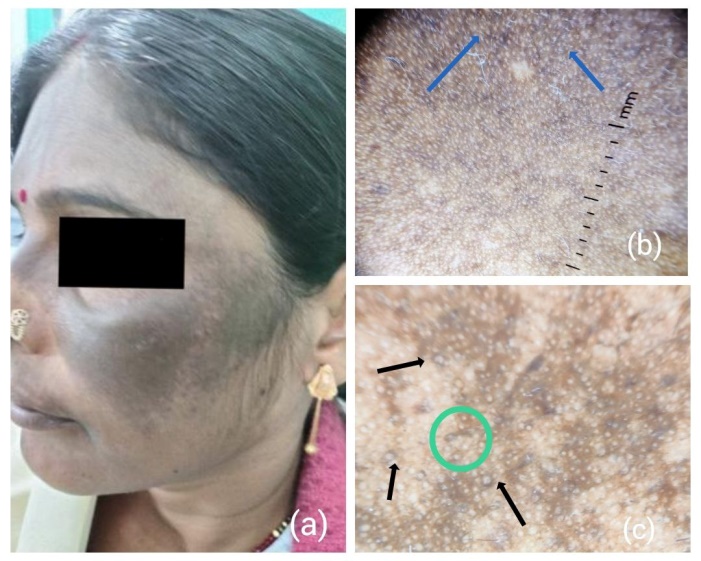 Exogenous ochronosis; a: Clinical image, b & c: Shows dermatoscopy blue arrows - Diffuse Brown background with white dots, black arrows- Irregular grey Brown, globular, annular and Aarciform structures, green circle- curvilinear and worm like structures