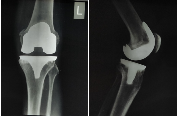 Radiographs of primary TKA, taken 3 years back
