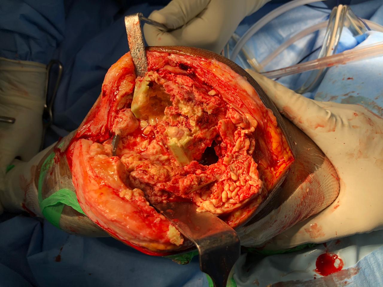  Intra-operative photograph after extraction of components showing extensive osteolysis of femoral condyles