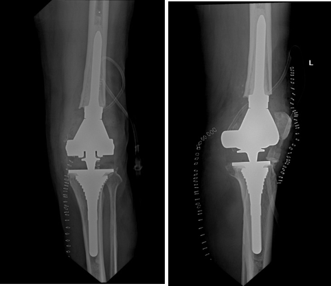 Radiograph of left knee after revision TKA