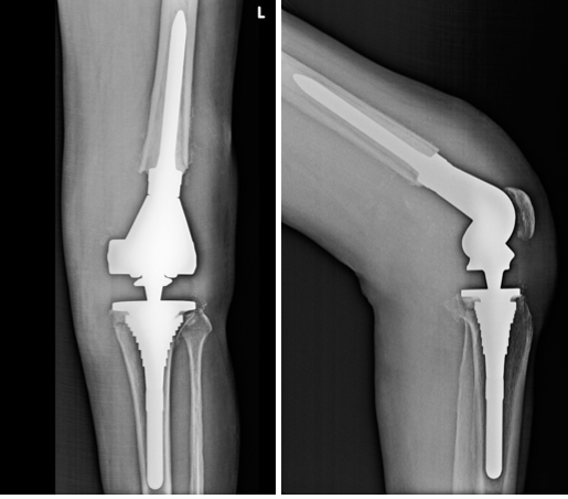  Radiograph of left knee at one year follow-up
