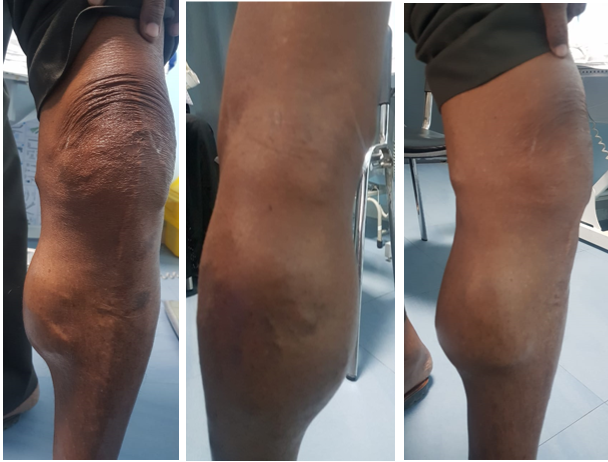 Clinical photographs of left leg showing a huge swelling in the popliteal and calf region