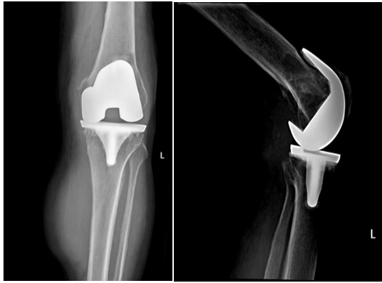 Pre- operative radiographs show loss of joint space between femoral andtibial components, periprosthetic osteolysis on both distal femur and proximal tibia, along with a soft tissue mass shadow in the posteromedial aspect