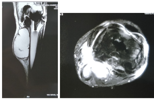 MRI images of the left leg showing large cystic mass extending from popliteal fossa to midcalf, communicating with the knee joint