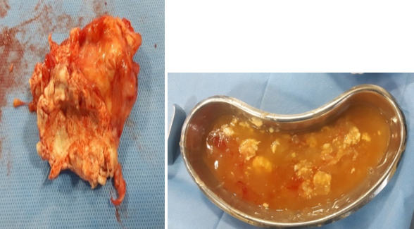 Image showing (a): Cystic mass (18cmx9cmx7cm) excised from the leg, and (b): Turbid fluid containing coarse granules evacuated from the cystic mass