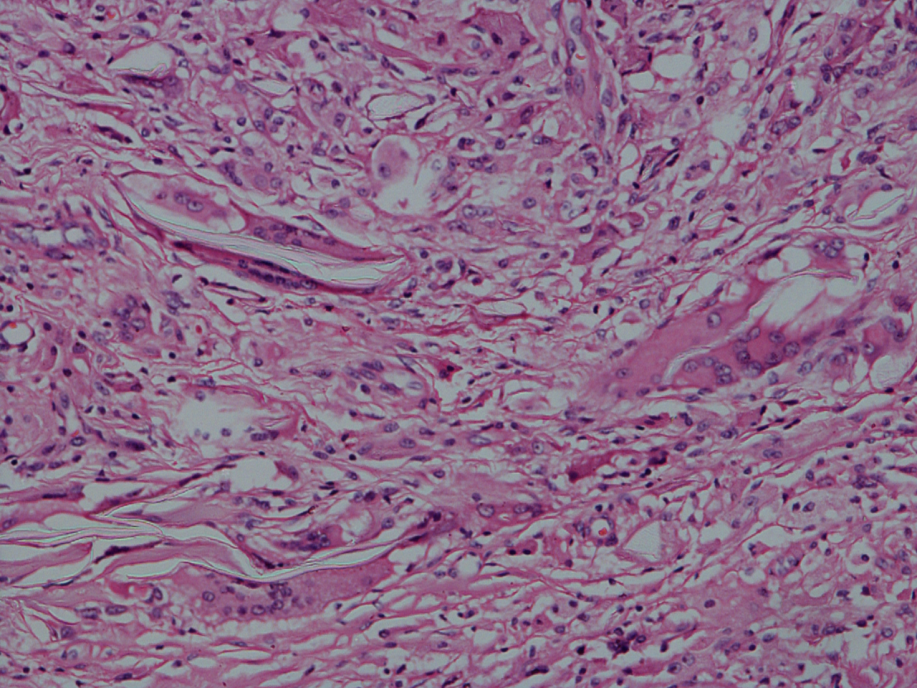 Histo-pathologic section shows a foreign body reaction with  giant cells around refractile material