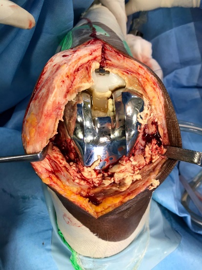 Intraoperative clinical photograph during revision TKA showing hypertrophiedsynovium