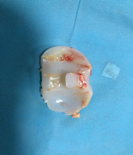 Photograph of delaminated, worn polyethylene insert