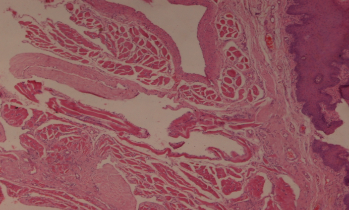 Histopathological examination of the lesion showed multiple dilated endothelial lined vessels just adjacent to squamous epithelium, filled with proteinaceous fluid and lymphocytes. Hematoxylin and Eosin x10X.