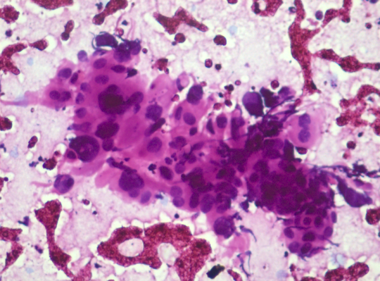 Squamous cell carcinoma metastasis. Photomicrograph showing dyscohesive clusters of malignant squamous cells showing nuclear atypia. H&E (x40)