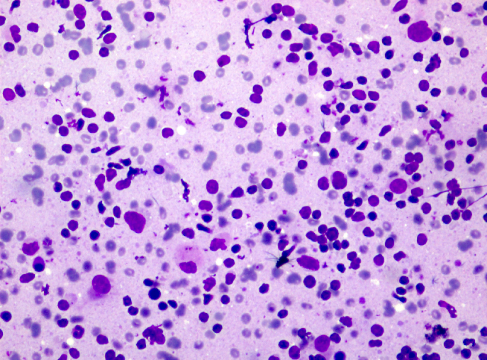 Photomicrograph showing monomorphous neoplastic small lymphocytes with scant cytoplasm and bare nuclei suggestive of NON-Hodgkin’s Lymphoma. Geimsa (x20)