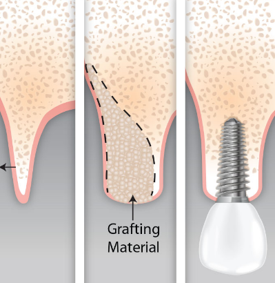 Placement of grafting material with immediate loading of implant