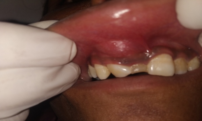 An intraoral swelling seen in the labial vestibular region extending from the frenum to the mesial aspect of 13