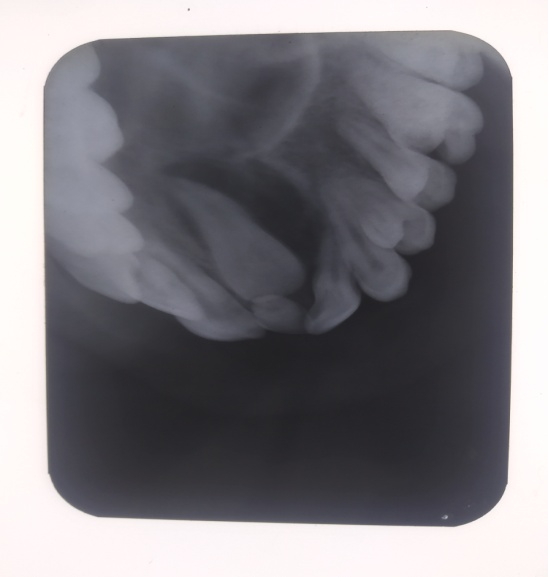 Occlusal radiograph determines the extension of the palate.
