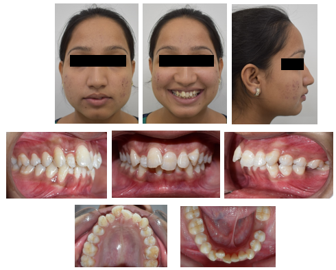 Pre-treatment extraoral and intraoral records