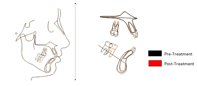 Superimposition of pre- and post- treatment cephalometric tracings