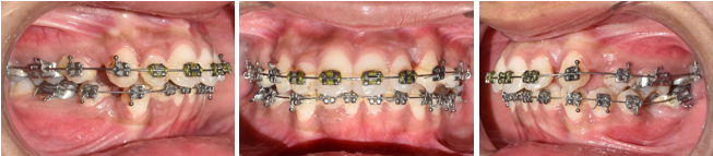 Patient during six months of levelling and alignment.