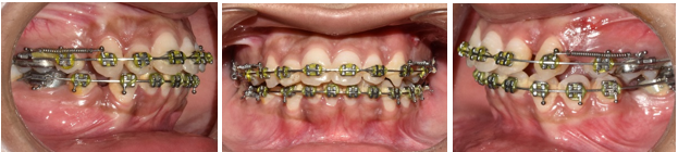 Patient after eleven months of treatment.