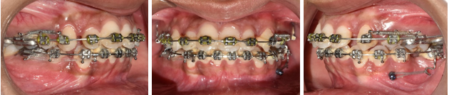 Protraction of mandibular left second molar.