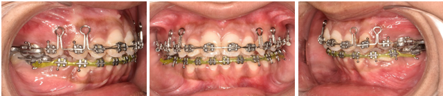 Patient after eighteen months of treatment.